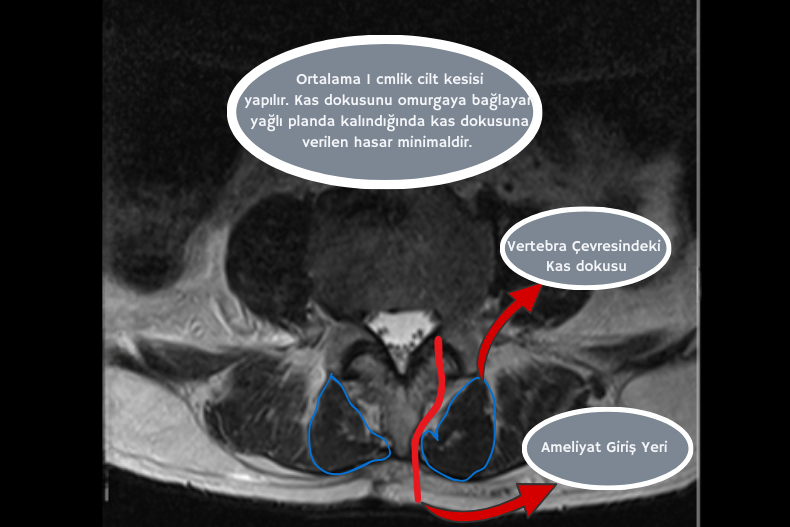 lomber mikrocerrahi diskektomide kas koruyucu ameliyat