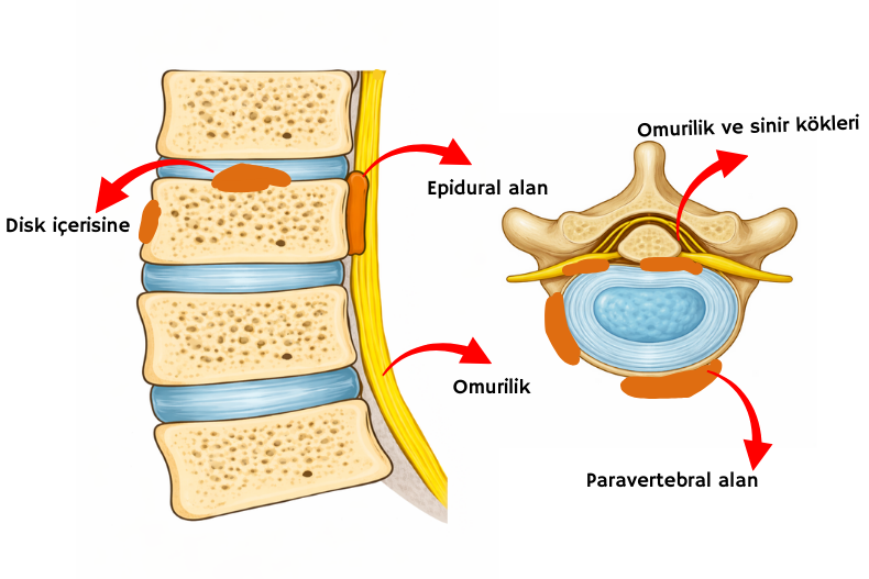 vertebraplasti sementinin disk içerisine, paravertebral alana omuriliğe basısı