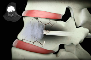 vertebroplasti ameliyatı