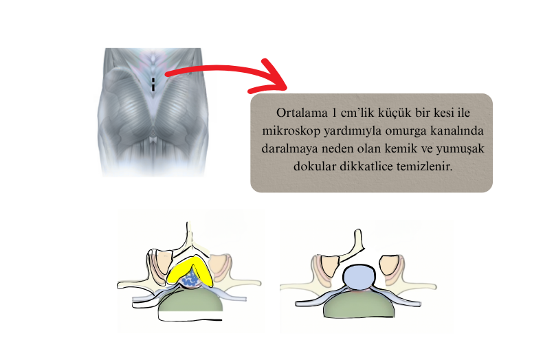 vidasız kanal daralması ameliyatı