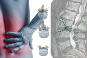 belde kanal daralması, spinal stenoz nedir?