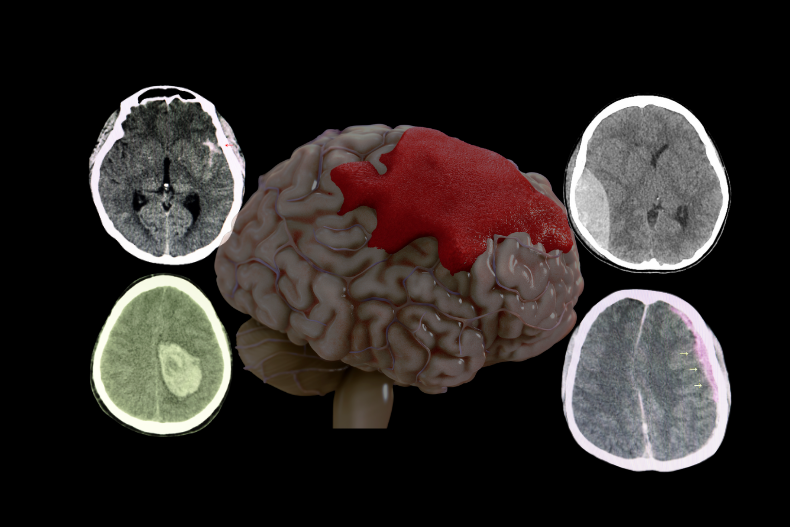 epidural, subdural, sak beyin kanaması