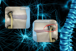bel kaymasıns bağlı sinir sıkışması, bel kayması ameliyatı
