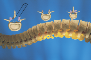 omurgada kanal daralması tedavisi, hemilaminektomi total laminektomi, minimal invaziv vidasız dar kanal tedavisi