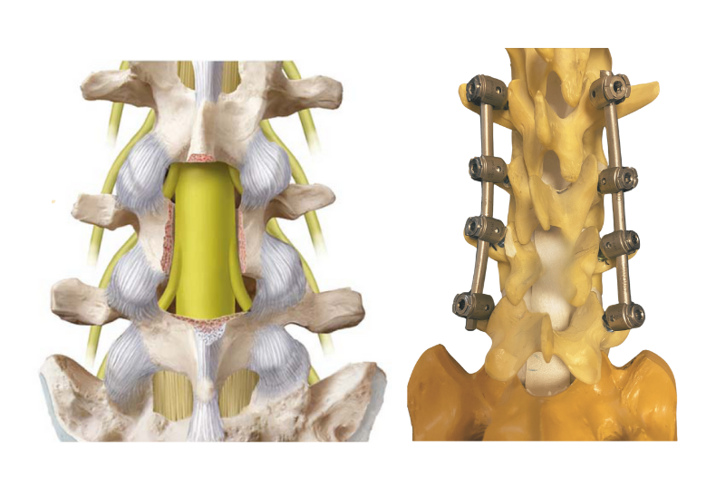 Platinli dar kanal ameliyatı