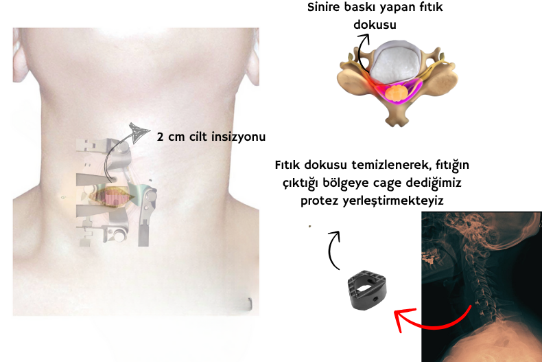 boyun fıtığı ameliyatı