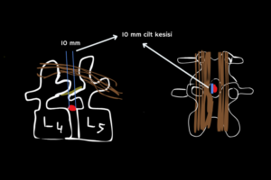 kapalı bel fıtığı ameliyatı