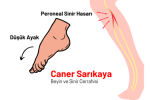 Düşük ayakta hangi sinir etkilenir-2