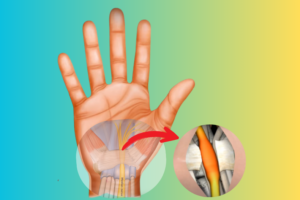 Karpal Tünel Sendromu Ameliyatı