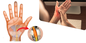 karpal tünel ameliyatı, median sinirin serbestleştirilmesi