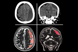 Subdural hematom tehlikeli mi