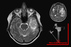 beyin tümörü mr görüntüsü, mikroskop ve endoskop