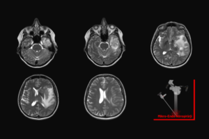 beyin tümörü ameliyatı