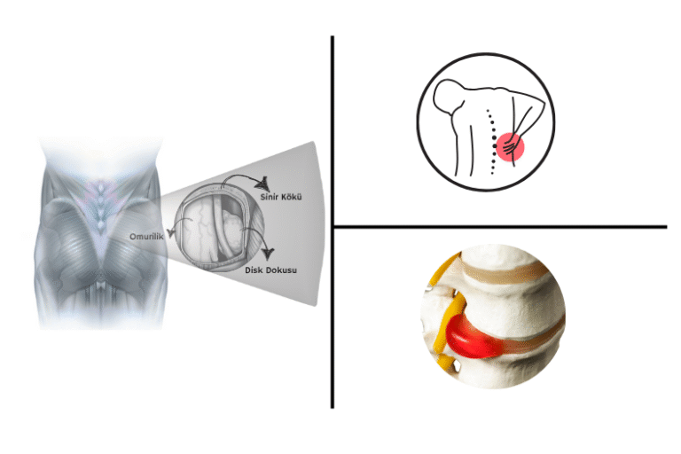 Bel Fıtığı Ameliyatı