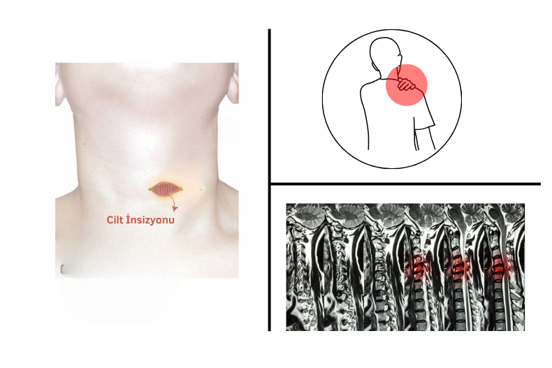 Boyun Fıtığı Ameliyatı