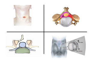 Kapalı Bel Fıtığı Boyun Fıtığı Kanal Darlığı Ameliyatı