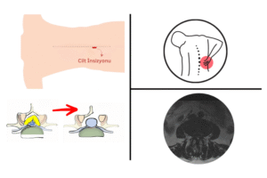 Kapalı Kanal Darlığı Ameliyatı
