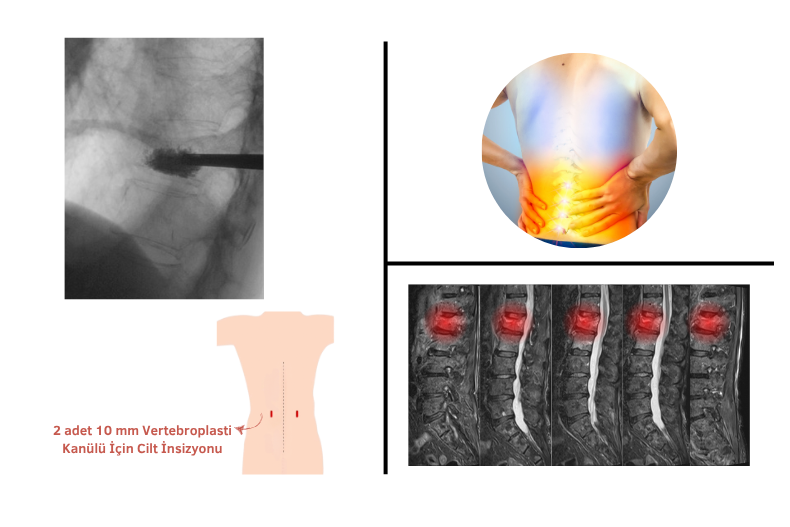 vertebroplasti, kifoplasti, osteoporotik kırık