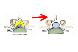Dar Kanal Ameliyatı Olanların Bilmesi Gerekenler