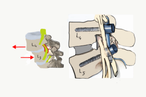 BEL KAYMASI AMELİYATI KAÇ GÜNDE İYİLEŞİR