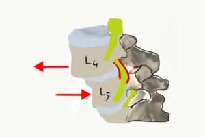 l4-5 bel kayması listezis,
