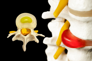 Bel fıtığı nedir?