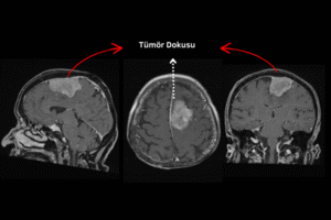 beyin tümörü mr görüntüsü