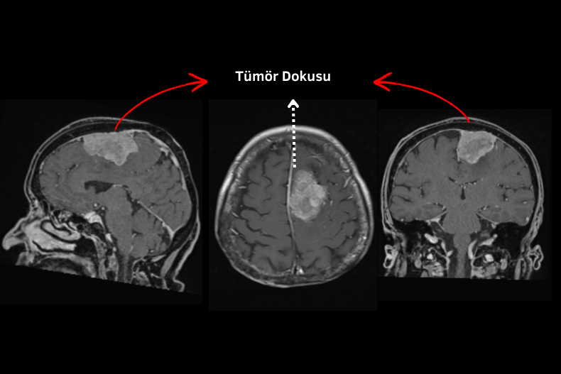 beyin tümörü mr görüntüsü