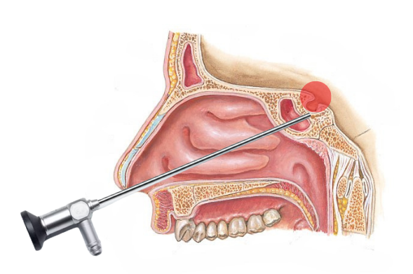 kapalı beyin tümörü ameliyatı, endoskopik hipofiz ameliyatı