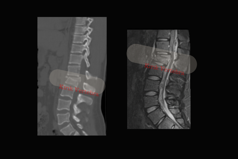L1 vertebra kırığı mr, bt görüntüsü