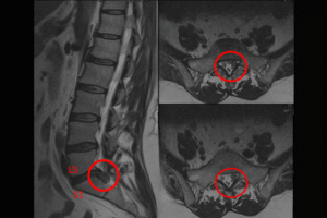 L5-S1 Bel fıtığı