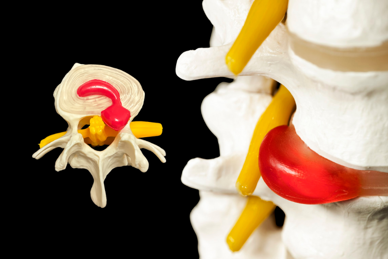 L5-S1 Bel Fıtığı Nedir