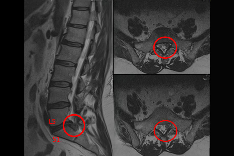 L5-S1 Bel fıtığı