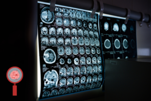 düşük dereceli beyin tümörü