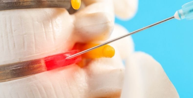 transforaminal epidural enjeksiyon,