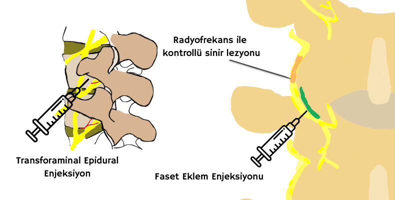 ameliyatsız bel kayması tedavisi, ameliyatsız bel fıtığı tedavisi, faset eklem enjeksiyonu, transforaminal epidural enjeksiyon