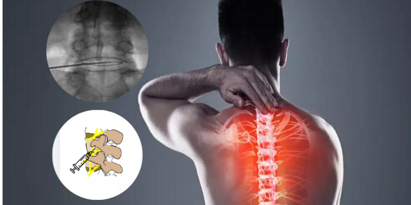 ameliyatsız bel fıtığı tedavisi, bel ağrısı tedavisi