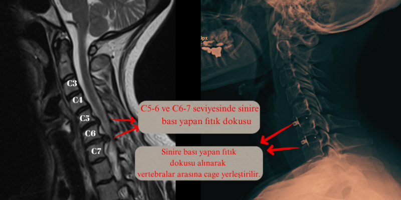 boyun fıtığı ameliyatı