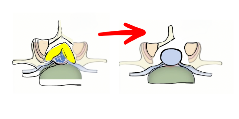 Dar Kanal Ameliyatı Olanların Bilmesi Gerekenler