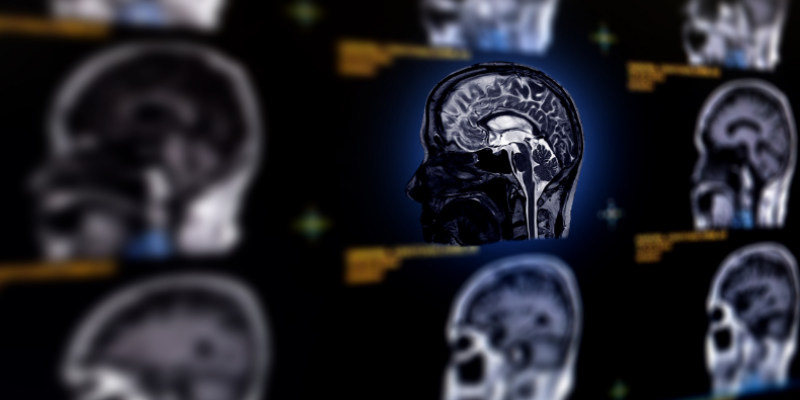 Glial kitle, glial tümör