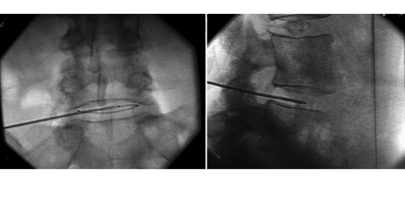 nükleoplasti yöntemi,