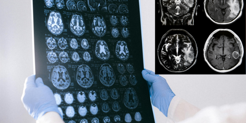 Yüksek Dereceli Beyin Tümörü (Glioblastom)