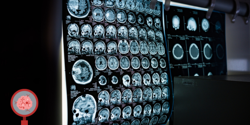 düşük dereceli beyin tümörü