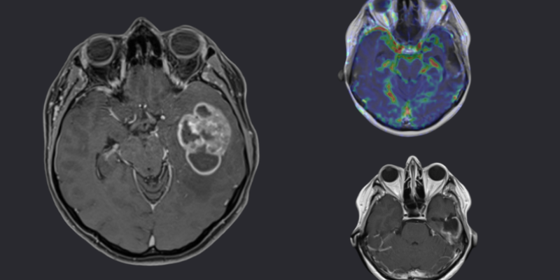 glioblastoma multiforme